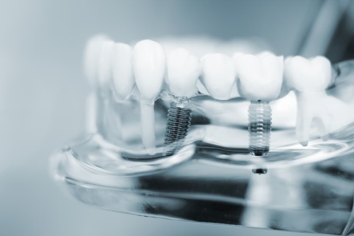 Implantationsprothetik